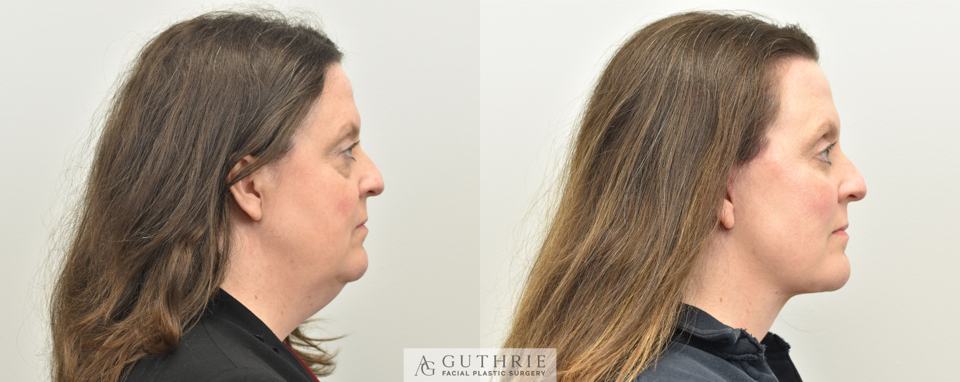 patient at guthrie facial plastic surgery before and after facelift procedure brentwood tn