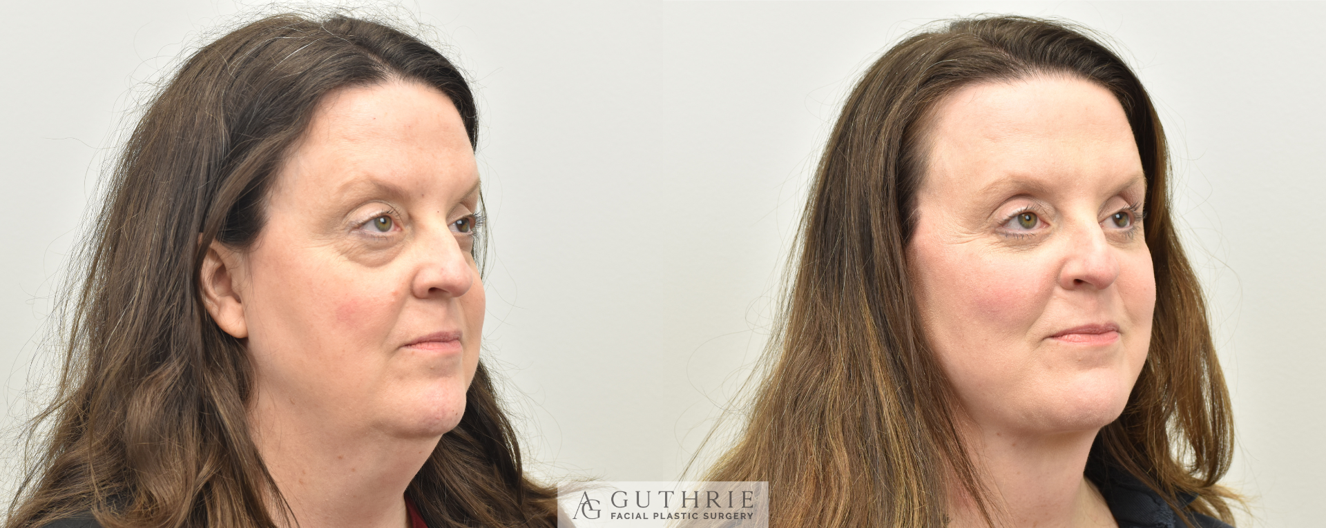 patient at guthrie facial plastic surgery before and after facelift procedure brentwood tn