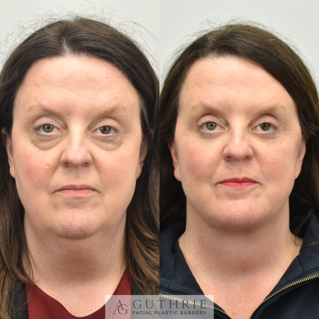 Before and After Lower Blepharoplasty with Fat Transfer