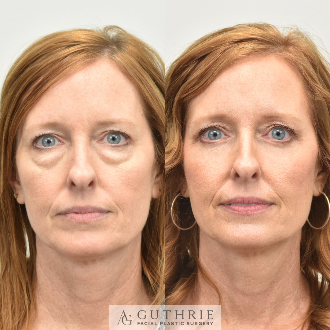 lower blepahroplasty in brentwood tn at guthrie facial plastic surgery before and after patient