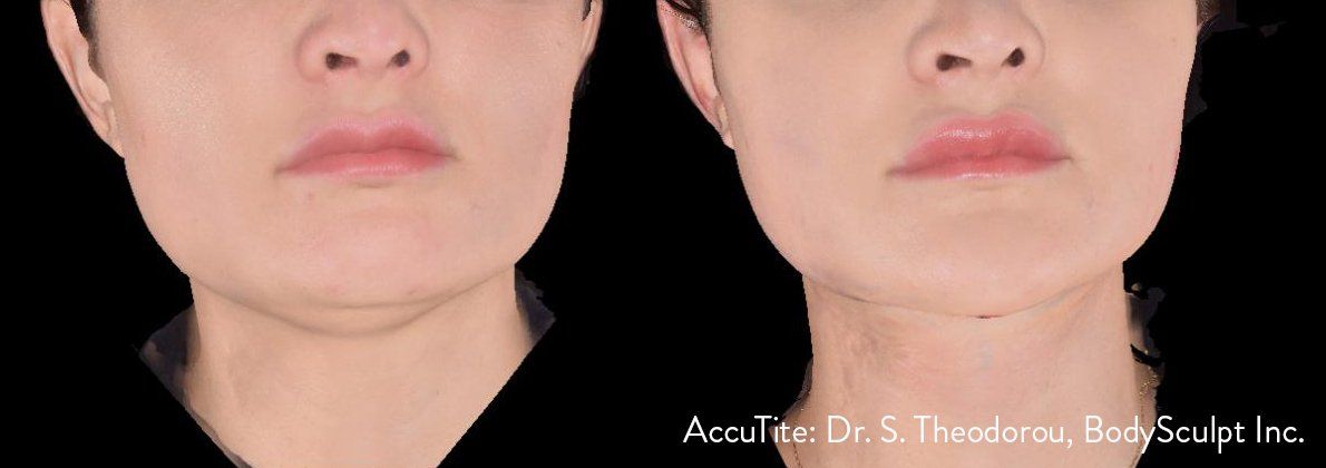 female patient before and after AccuTite treatment