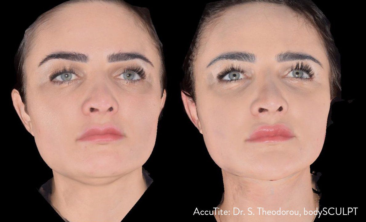 facial contouring - before and after