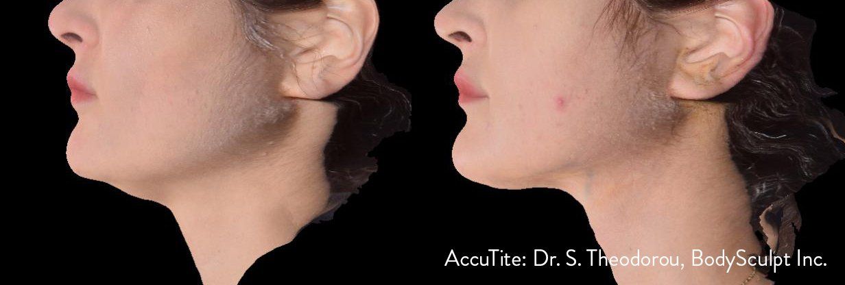 Accutite - Before and After
