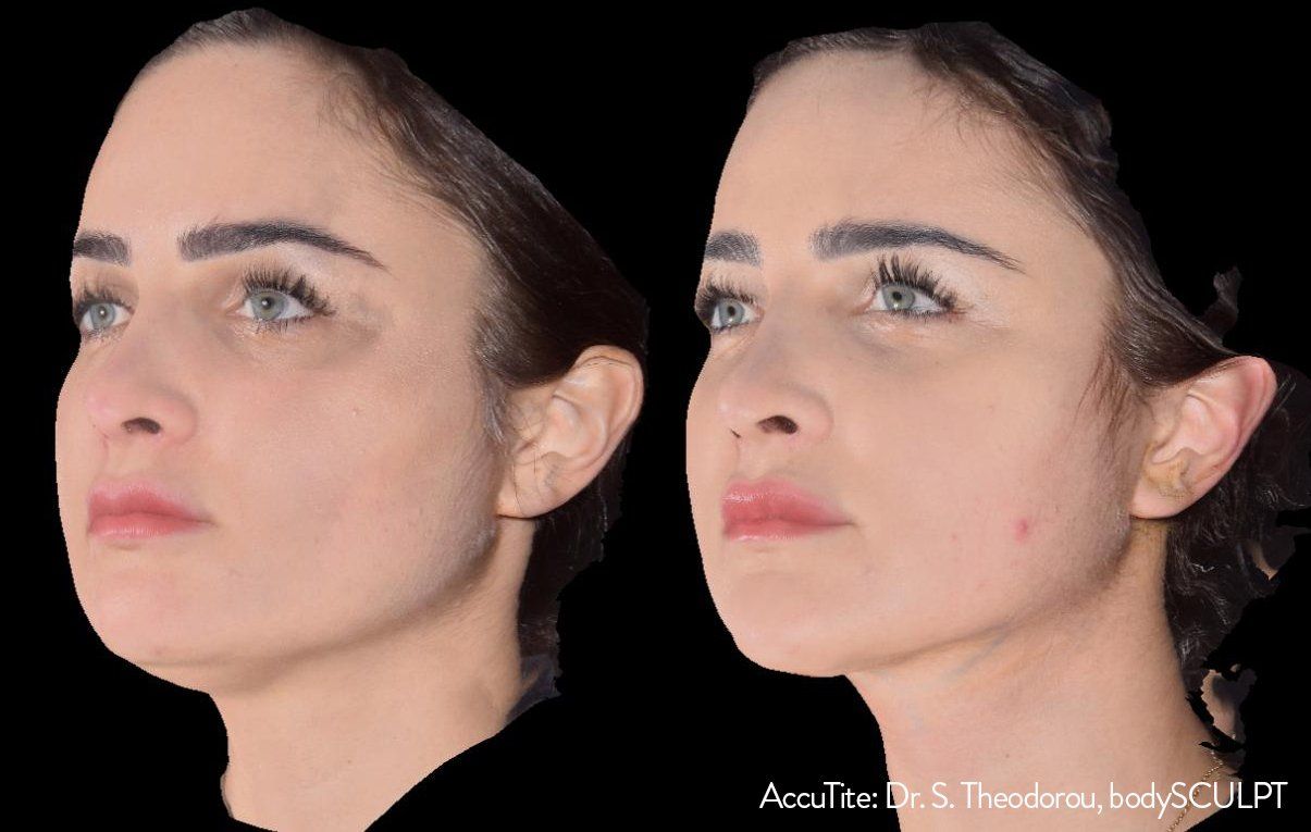 a woman's face before and after AccuTite treatment