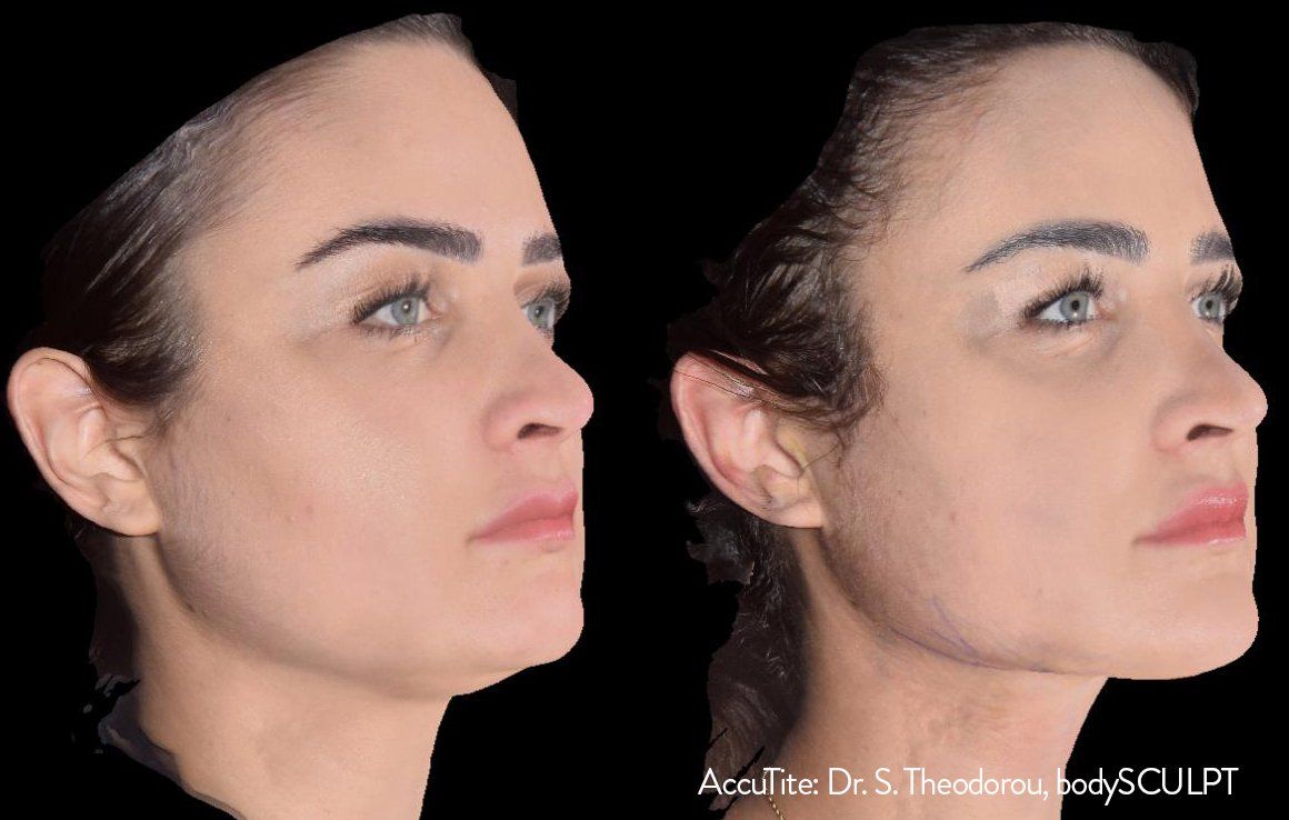 Before and after  - Accutite