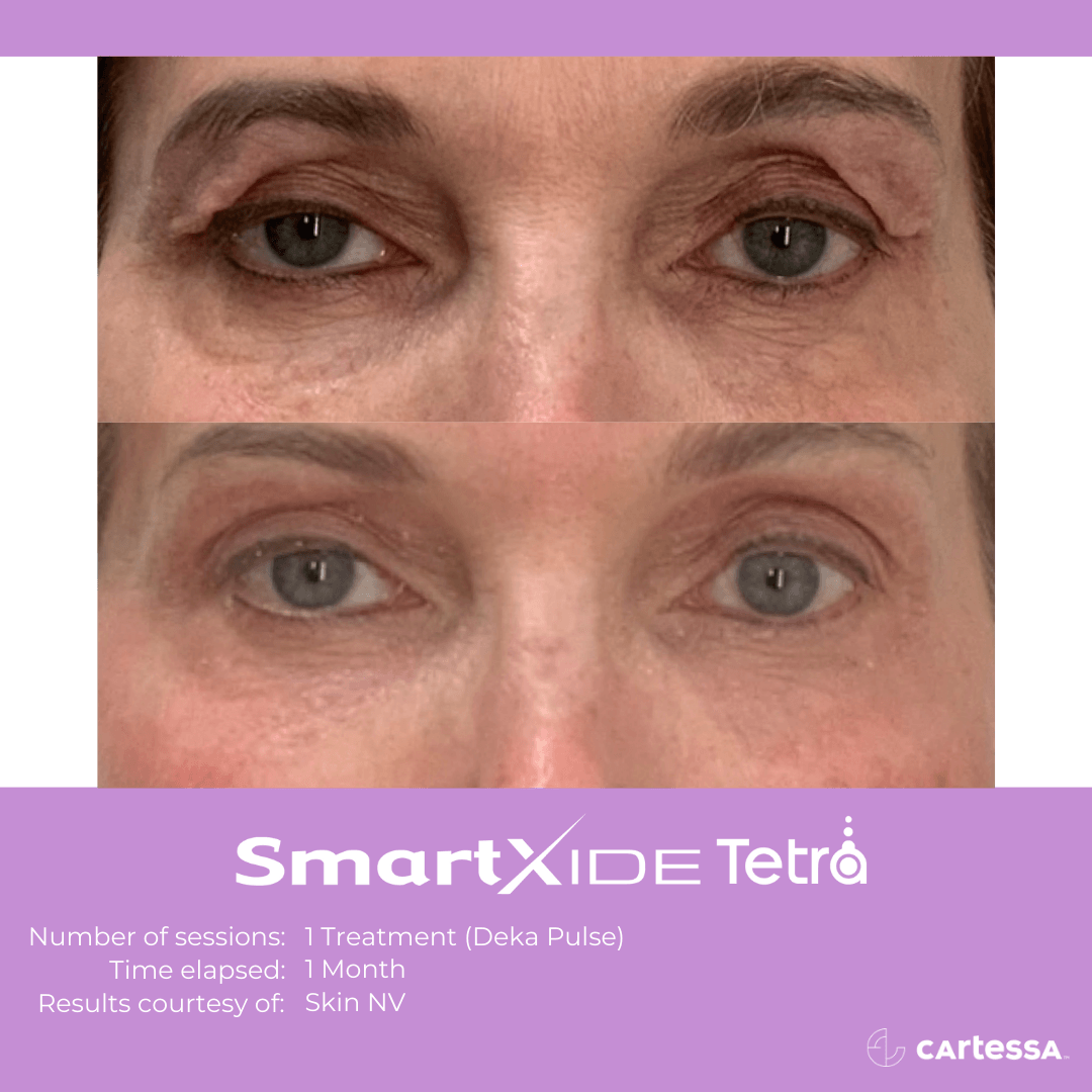 female patient before and after 1 tetra co2 laser treatment on the eyes