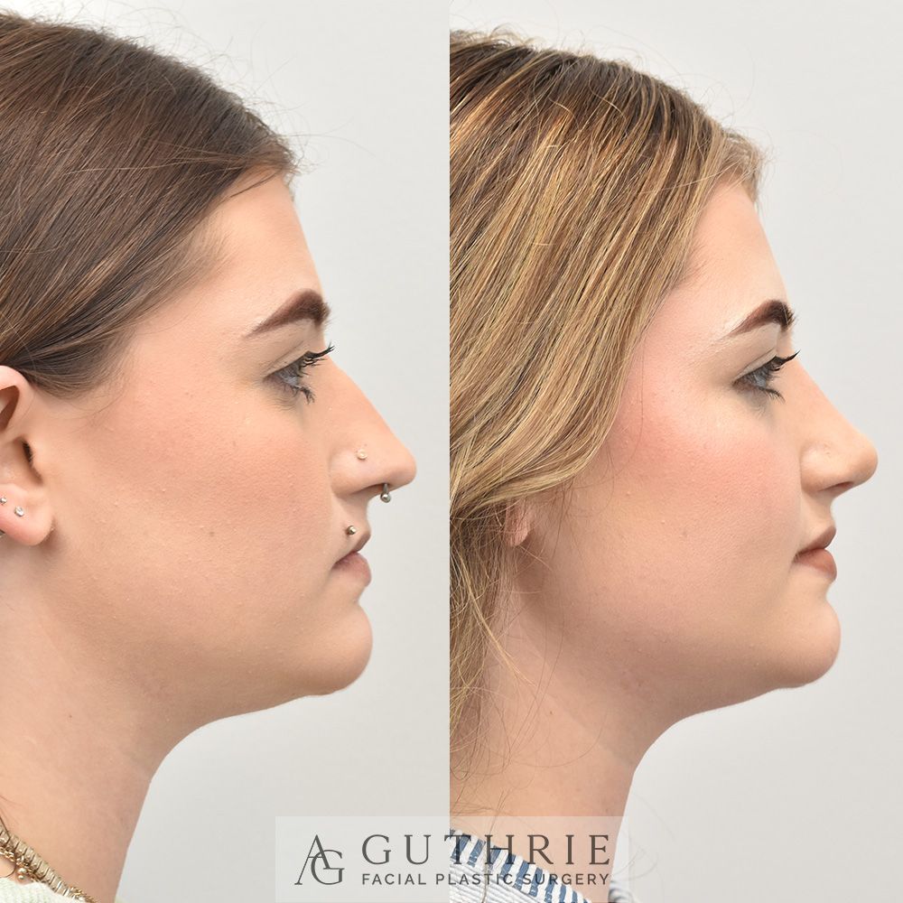 young woman's face before and after rhinoplasty procedure