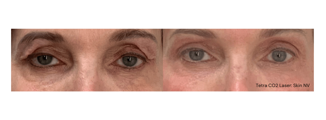 closeup of patient's eye area before and after Tetra CO2 laser treatment