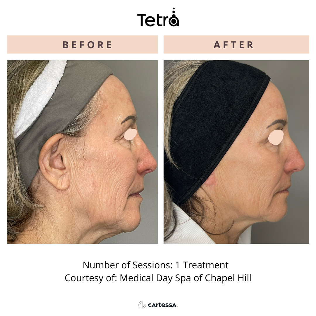 woman's face Before and After Tetra CO2 Laser Resurfacing Treatment