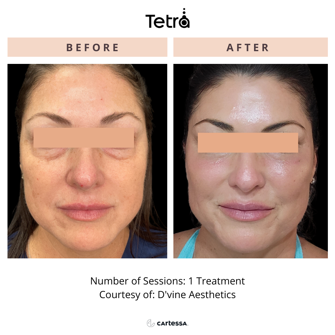 Before and After Tetra CO2 Laser Resurfacing Treatment