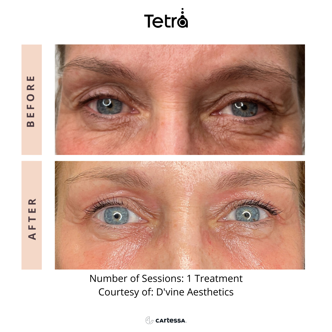 closeup of patient's eye area Before and After Tetra CO2 Laser Resurfacing Treatment