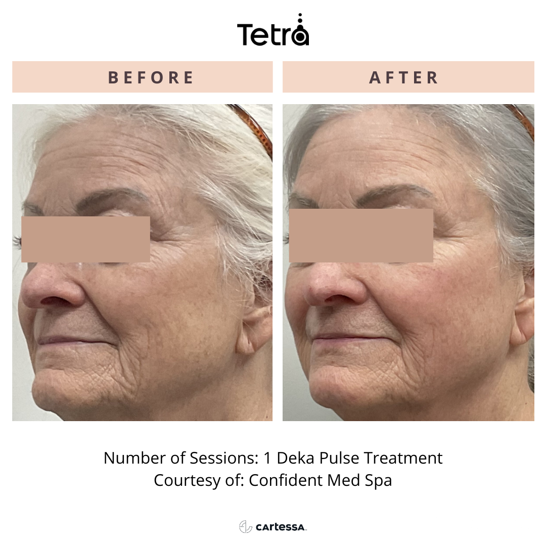 Before and After Tetra CO2 Laser Resurfacing Treatment