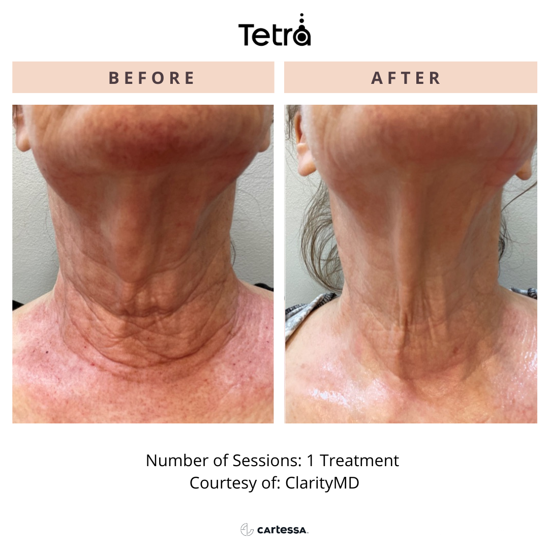 closeup of patient's neck Before and After Tetra CO2 Laser Resurfacing Treatment