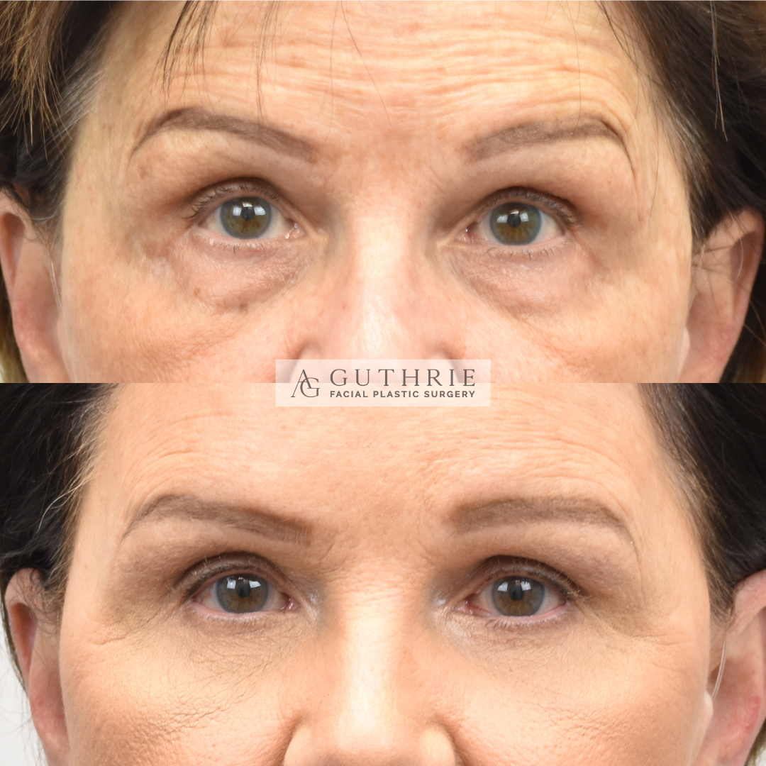 guthrie facial plastic surgery patient before and after upper and lower blepharoplasty with brow lift - brentwood nashville tn