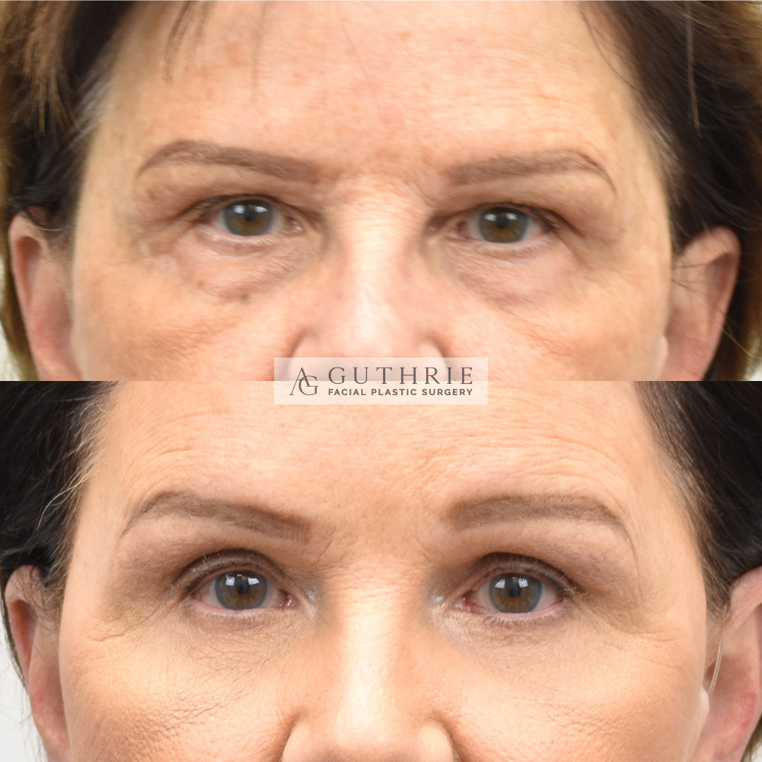 Before and After Upper and Lower Blepharoplasty