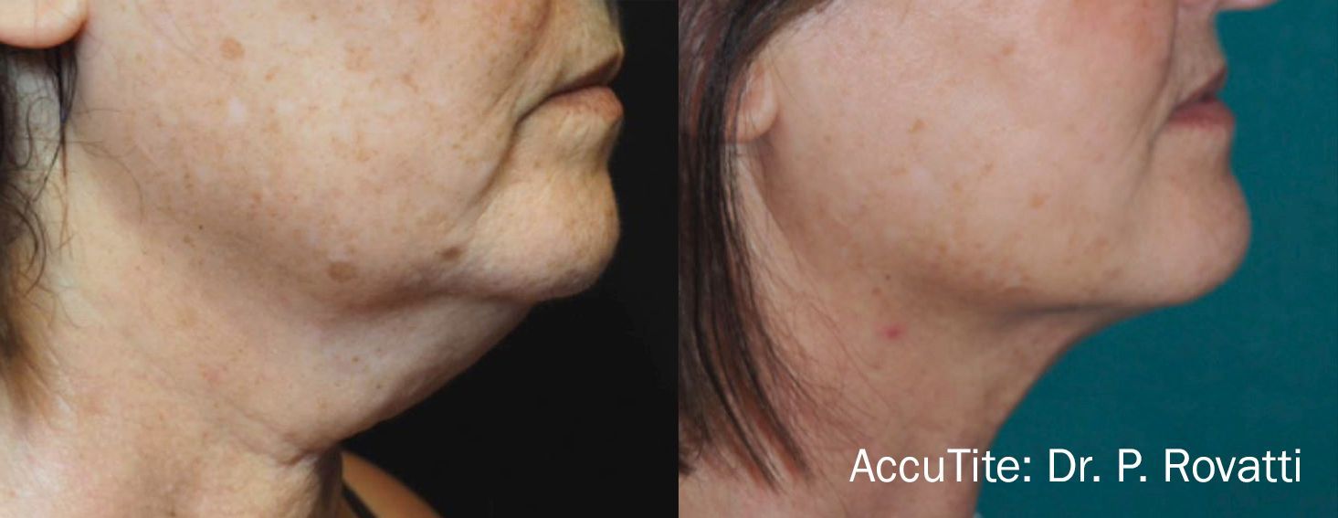 a woman's neck area before and after AccuTite treatment for sagging skin