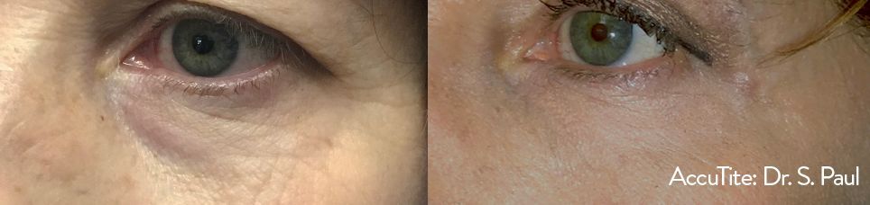 a woman's eye area before and after AccuTite treatment for undereye bags