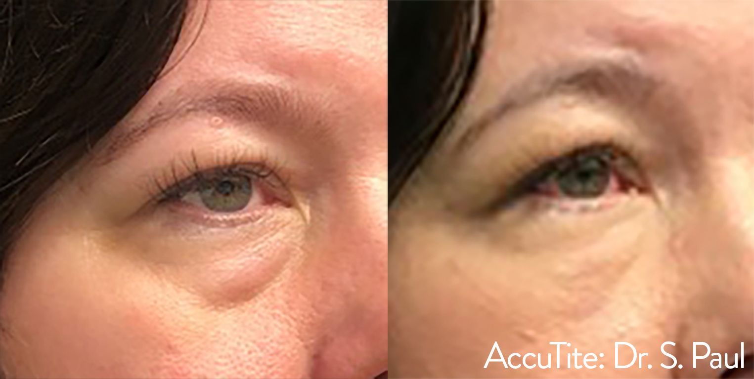 a woman's eye area before and after AccuTite treatment