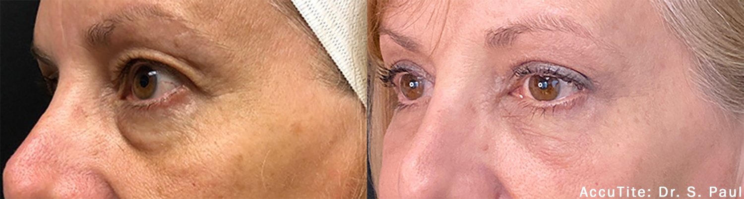 a woman's eye area before and after AccuTite treatment for undereye bags