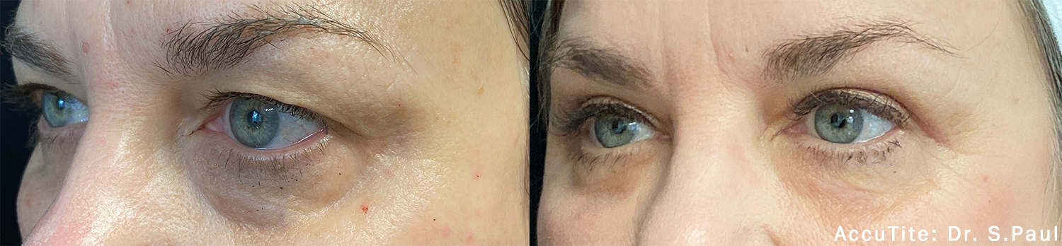 a woman's eye area before and after AccuTite treatment for undereye bags