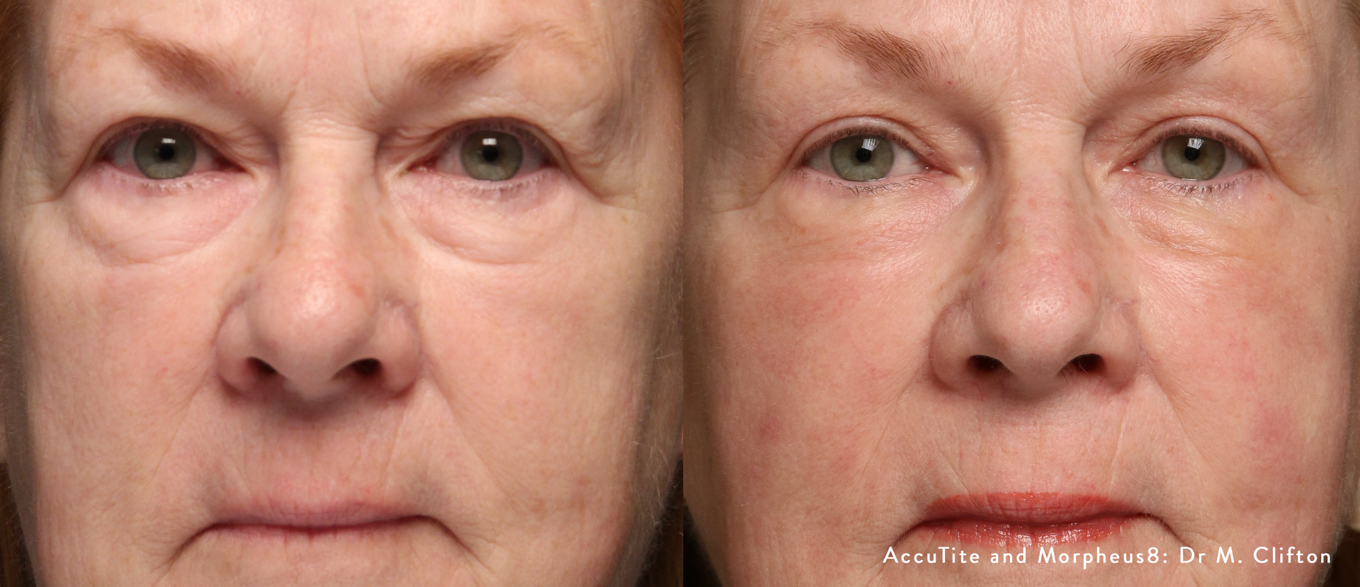 a woman's face before and after AccuTite treatment