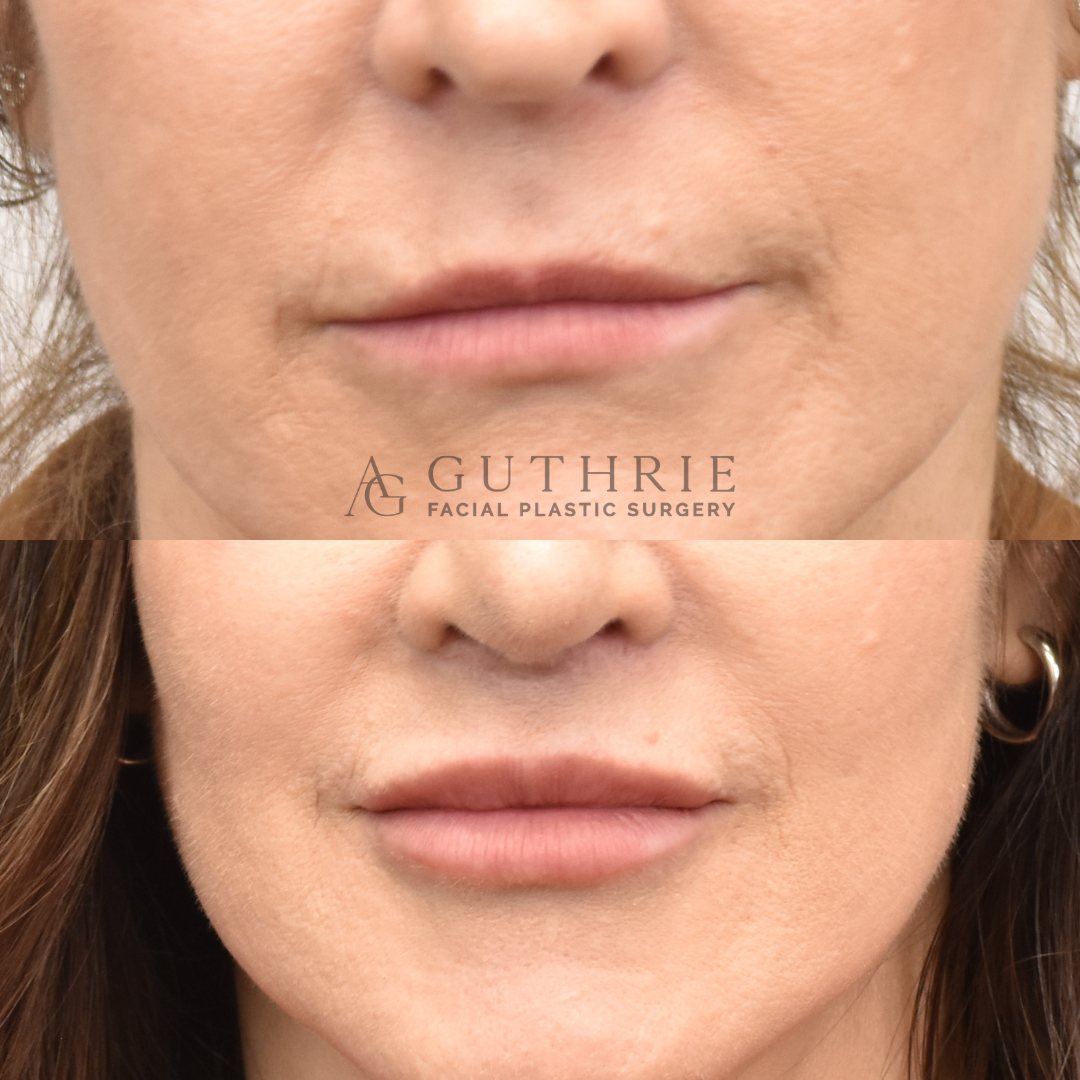 patient at guthrie facial plastic surgery before and after lip lift
