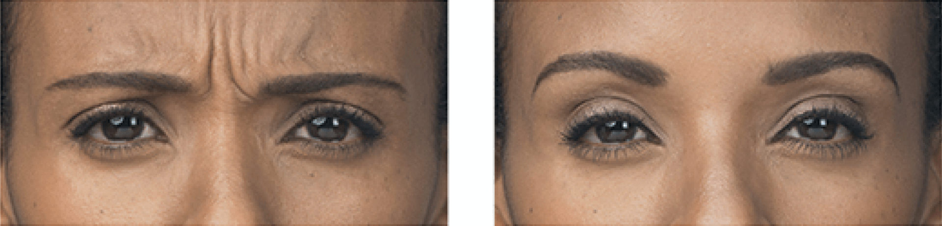 patient before and after BOTOX treatment