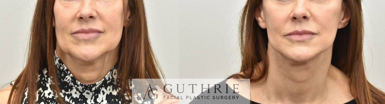 a woman's face before and after deep plane facelift procedure