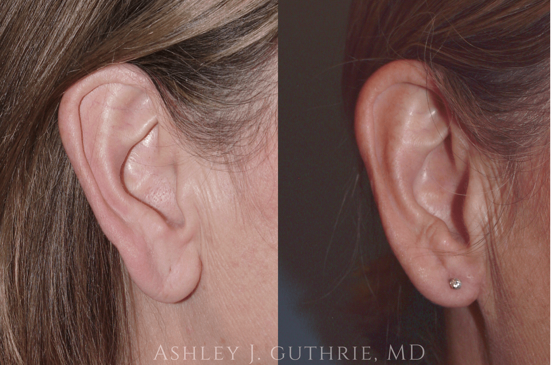woman's ears before and after earlobe reduction