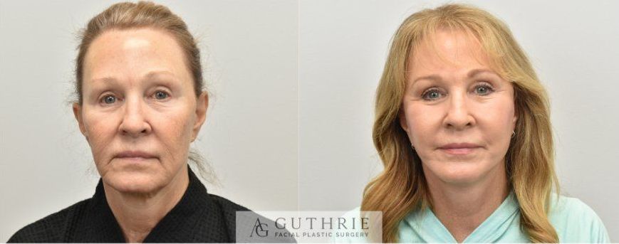a before and after photo of a woman's face for facelift example