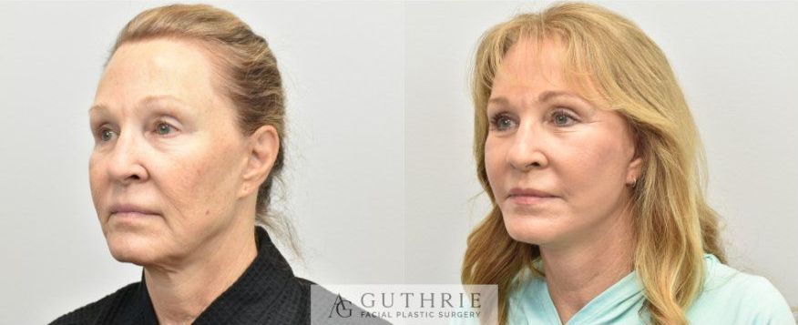 a before and after photo of a woman's face for facelift example