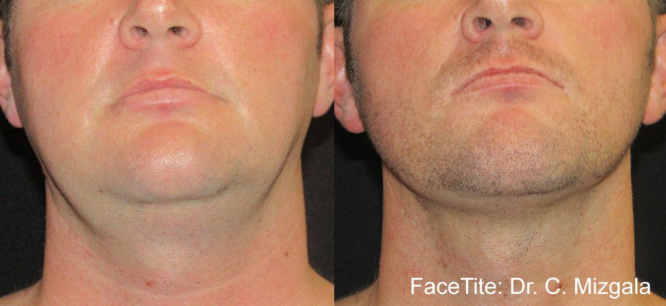 a patient shown before and after FaceTite treatment