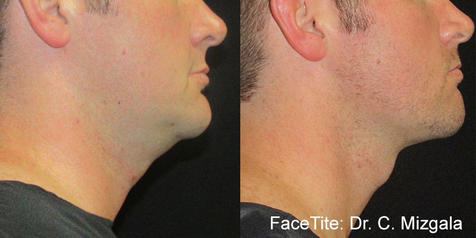 a patient shown before and after FaceTite treatment