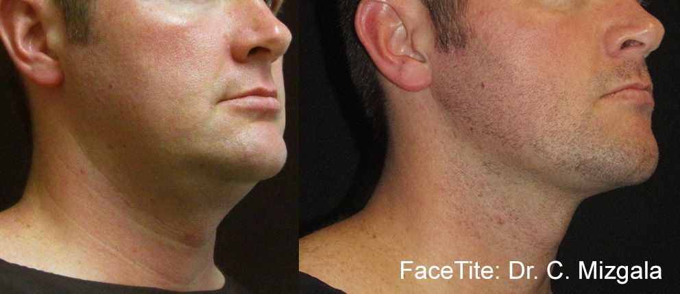 a patient shown before and after FaceTite treatment