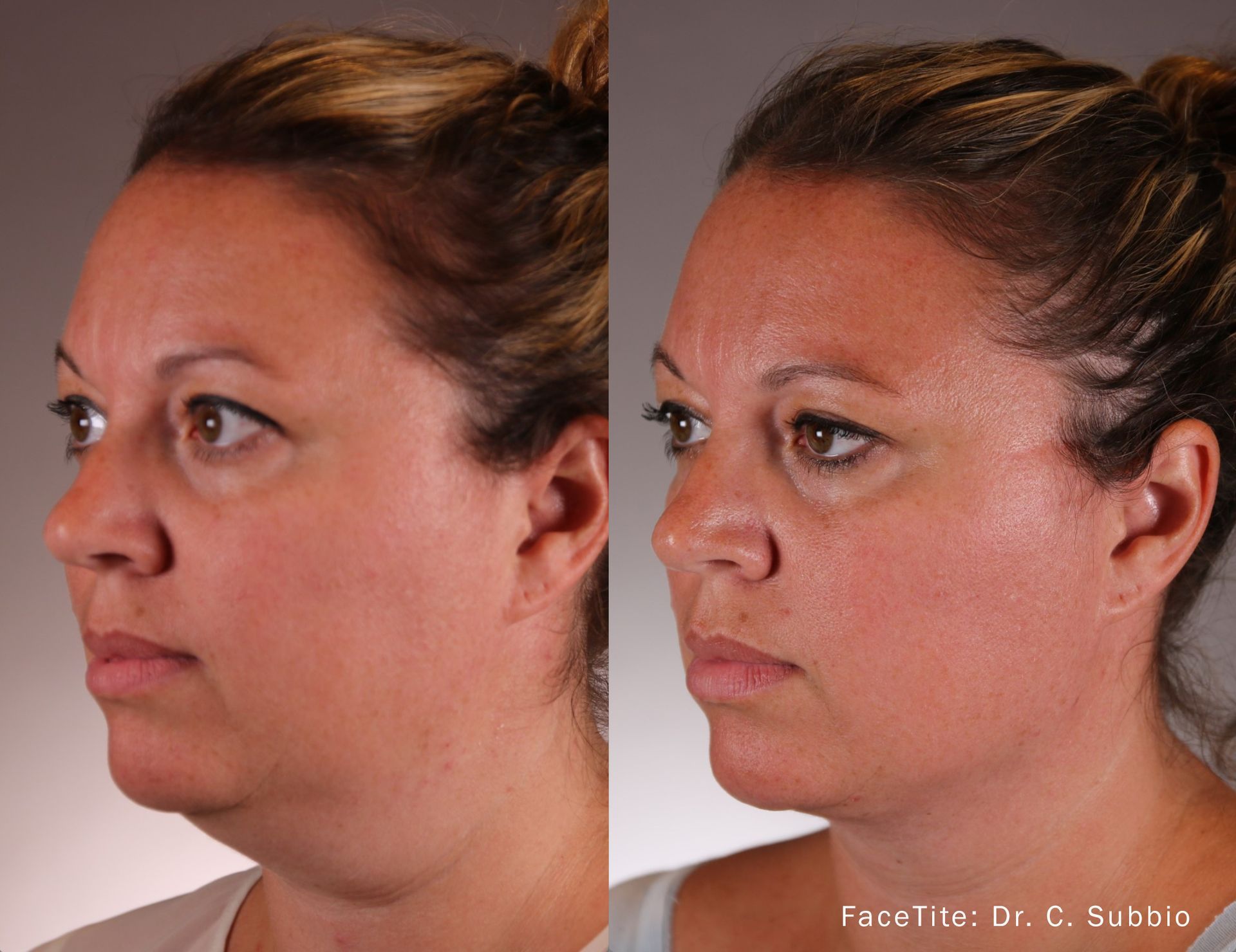 a patient shown before and after FaceTite treatment