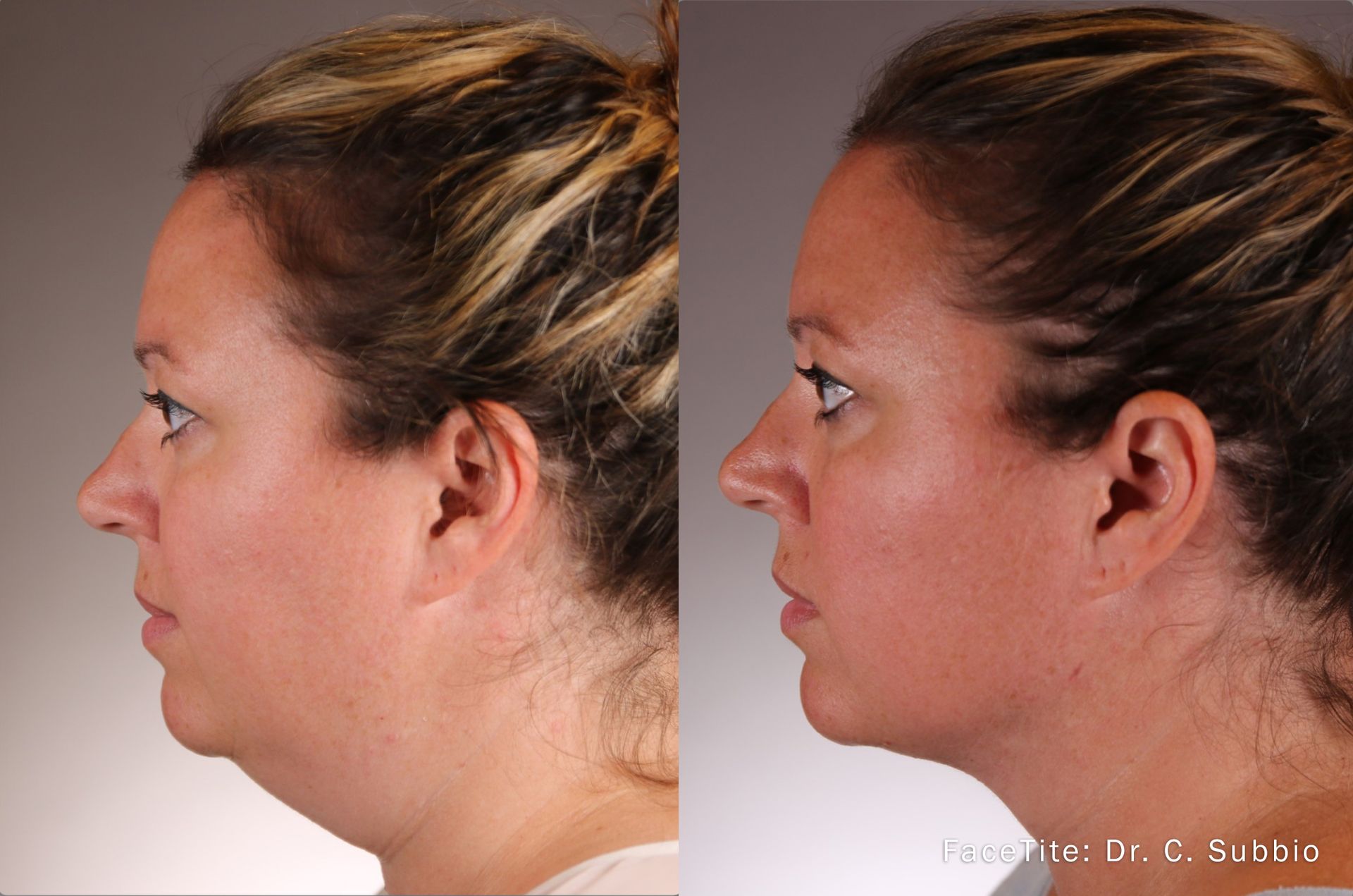 a patient shown before and after FaceTite treatment