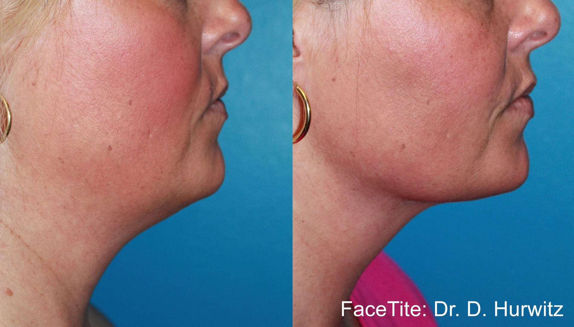 Before and After FaceTite Treatment, with Morpheus8