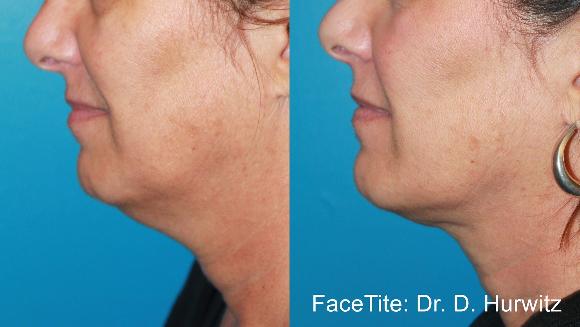 a patient shown before and after FaceTite treatment