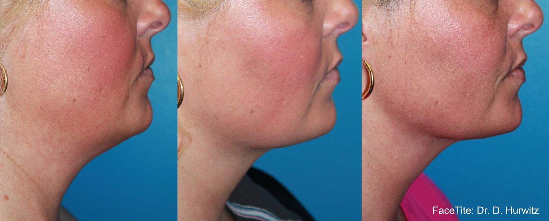 a patient shown before and after FaceTite treatment