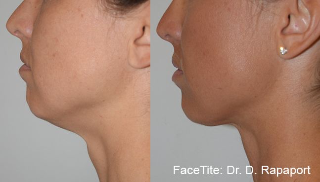 a patient shown before and after FaceTite treatment