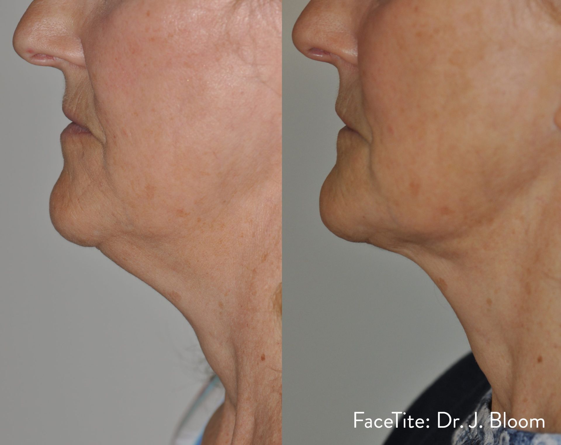 a patient shown before and after FaceTite treatment