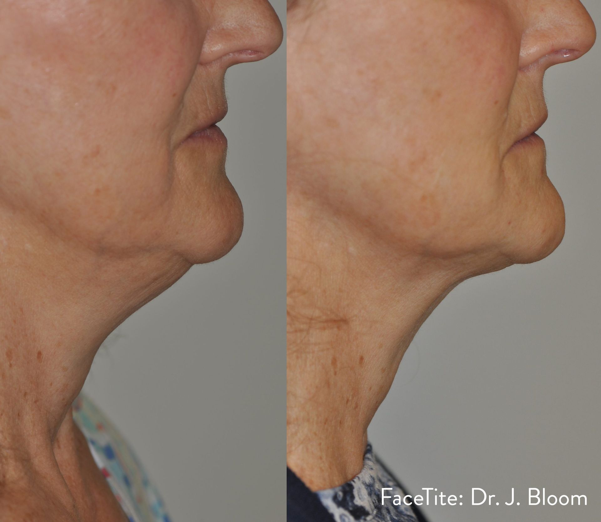 a patient shown before and after FaceTite treatment