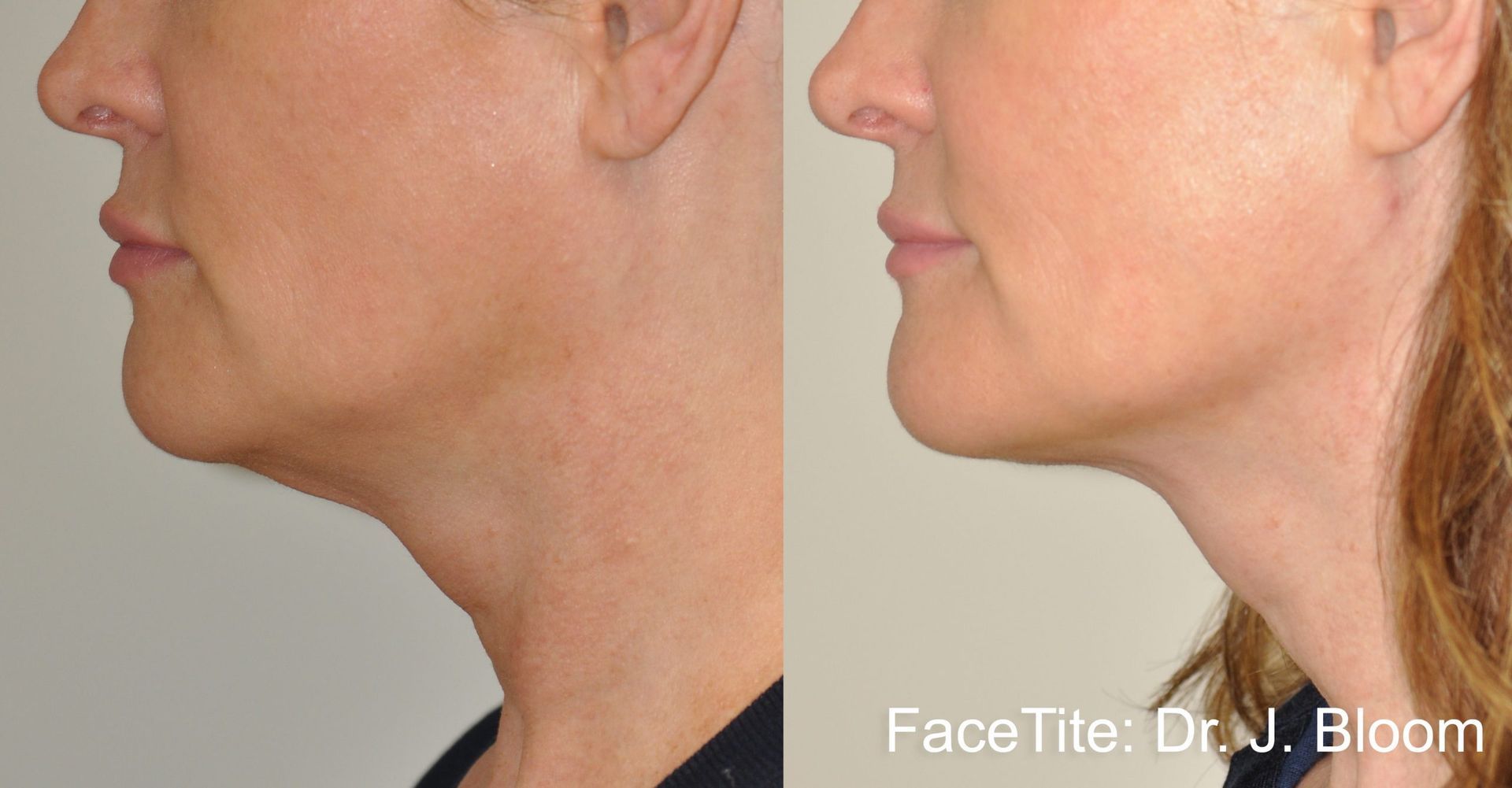 a patient shown before and after FaceTite treatment