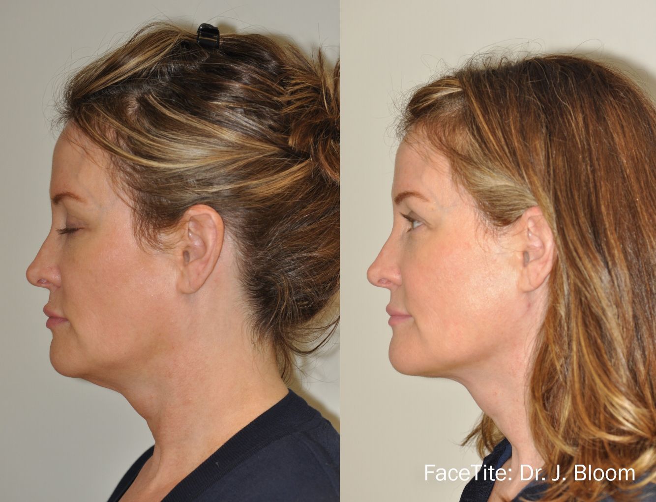 a patient shown before and after FaceTite treatment