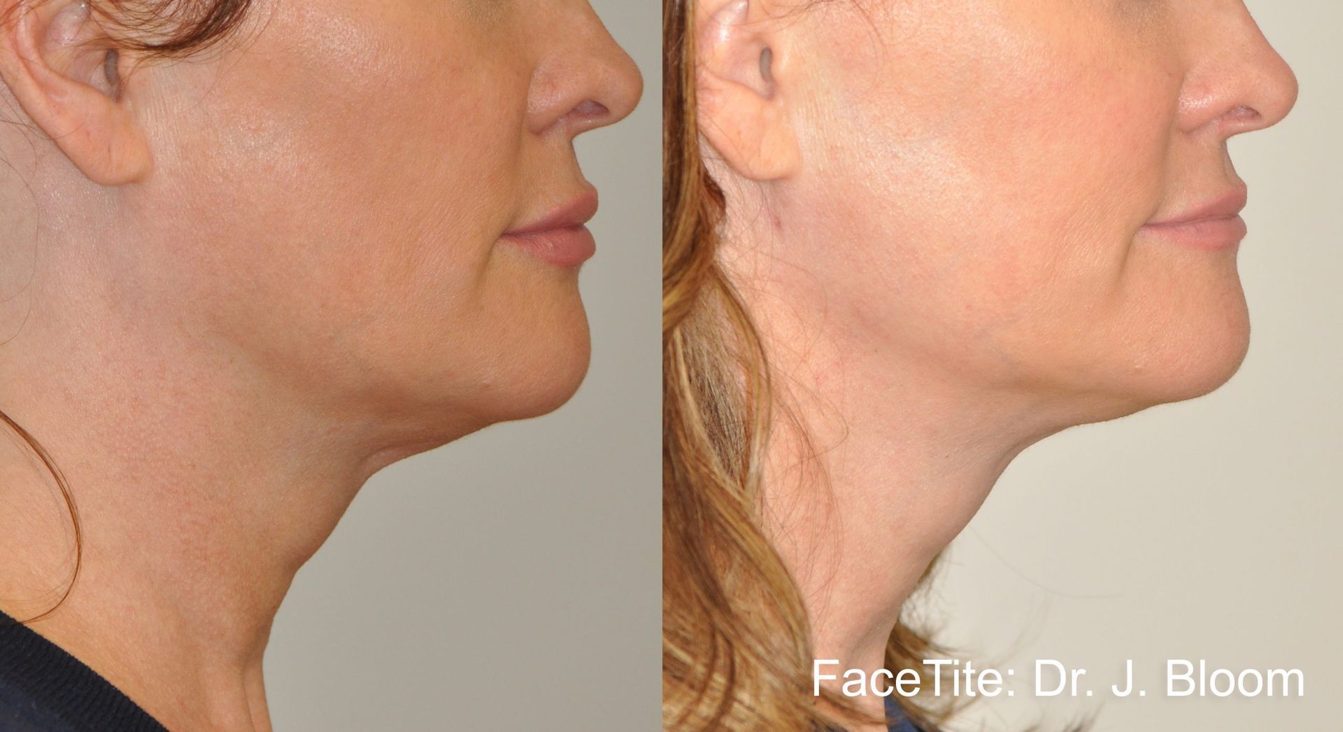 a patient shown before and after FaceTite treatment