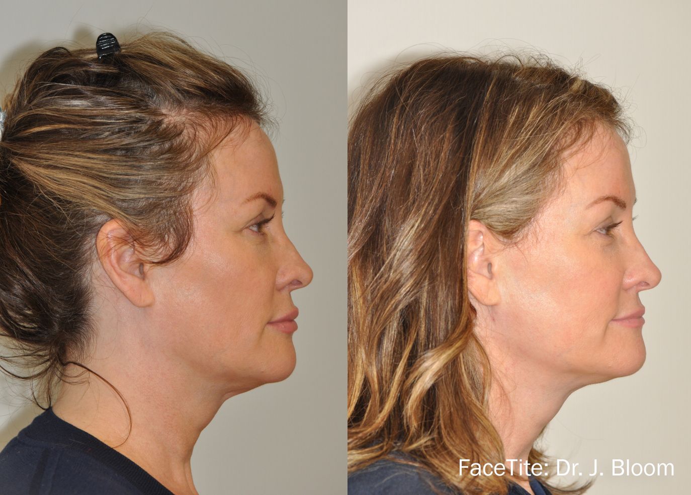 a patient shown before and after FaceTite treatment