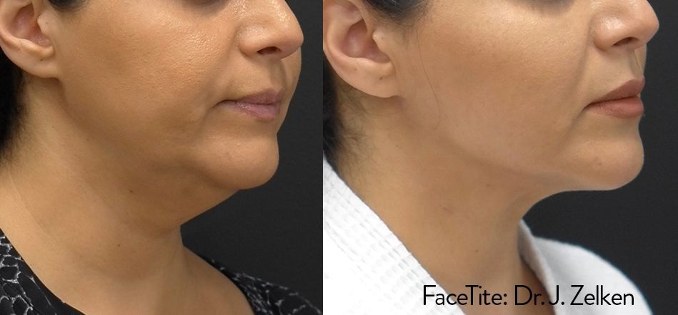 a patient shown before and after FaceTite treatment