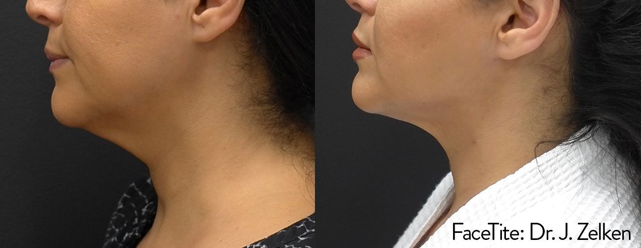 a patient shown before and after FaceTite treatment