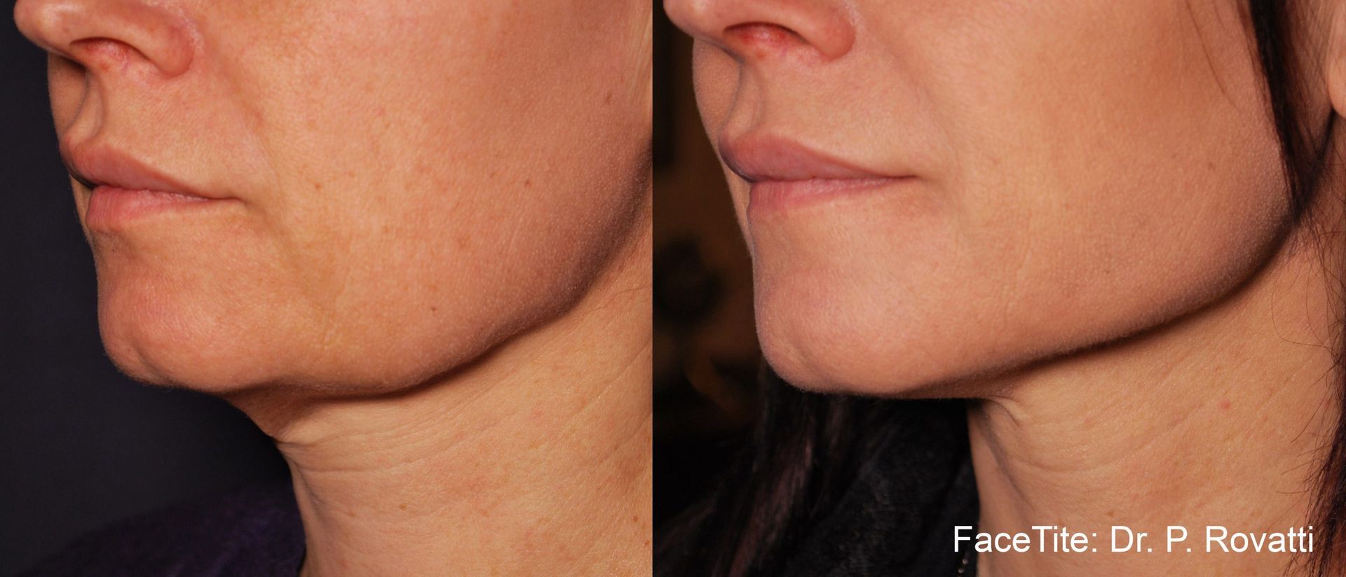 a patient shown before and after FaceTite treatment