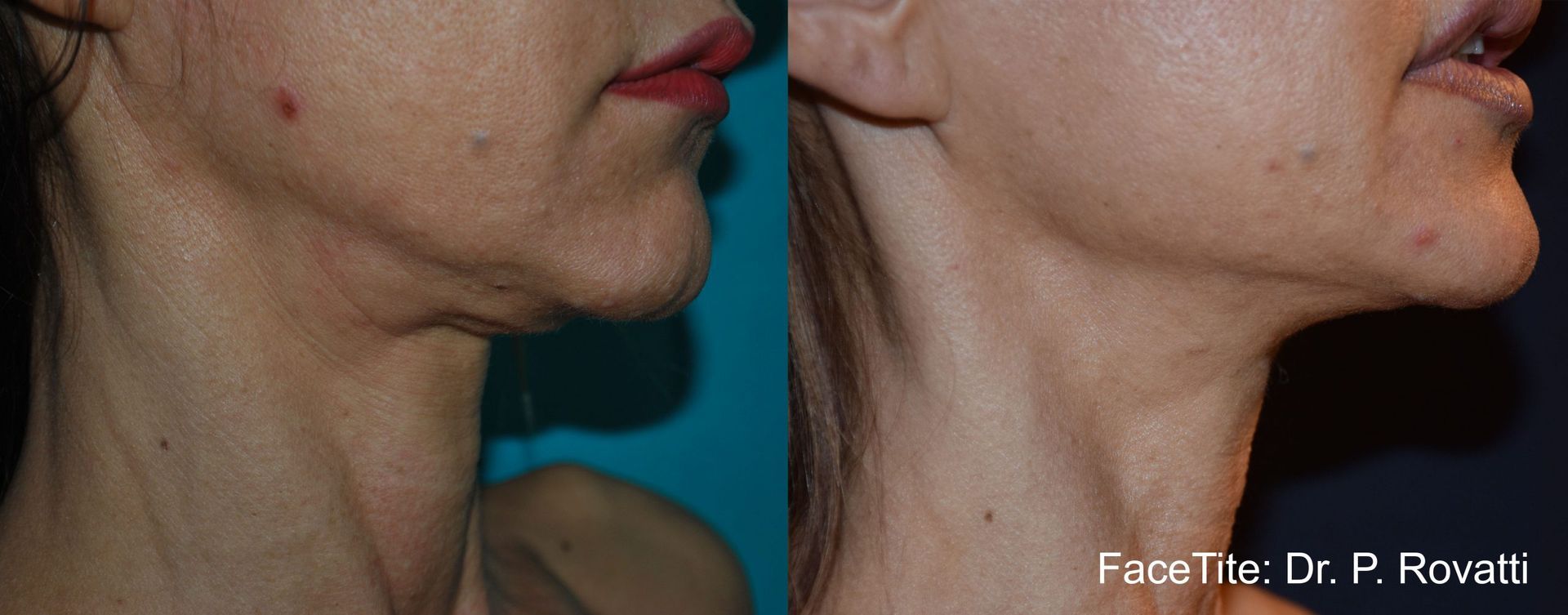 a patient shown before and after FaceTite treatment